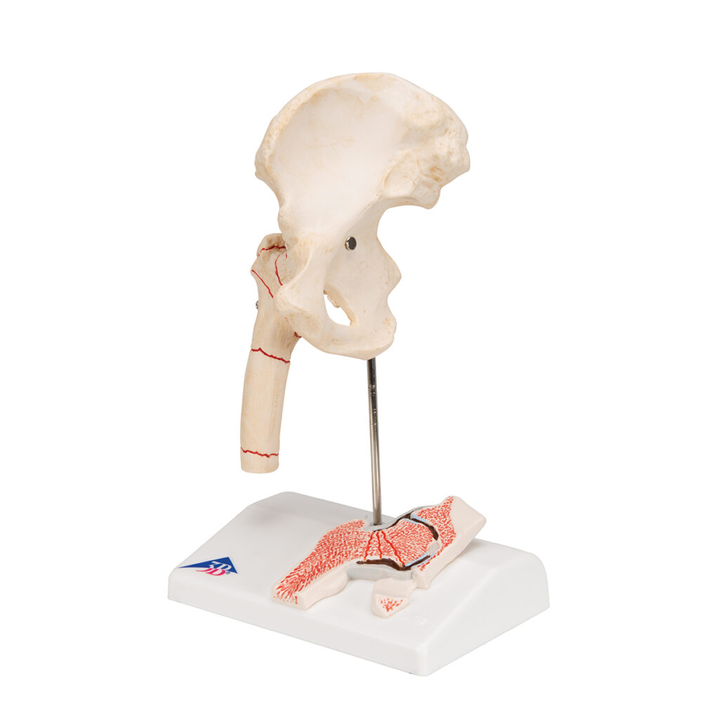 Femoral Fracture and Hip Osteoarthritis Anatomical Bone Model Physio