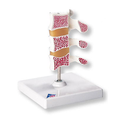 deluxe-osteoporosis-anatomical-model