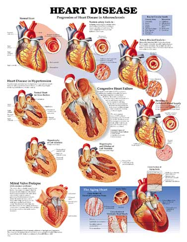 heart-disease-anatomical-poster