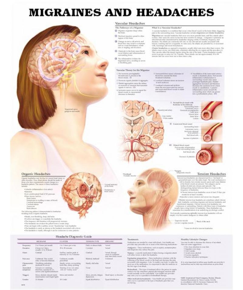 migraine-headache-anatomical-chart