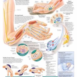 Understanding Carpal Tunnel Syndrome Educational Chart