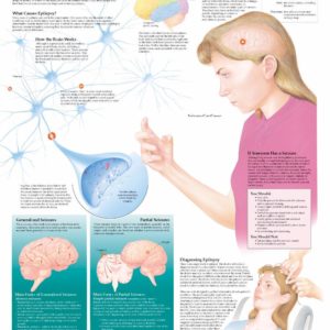 Understanding Epilepsy Anatomical Chart